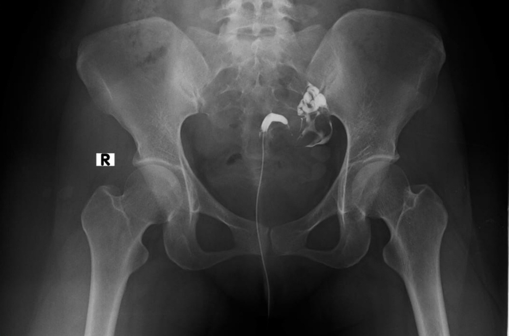 hysterosalpingography pueblo radiology medical group santa barbara